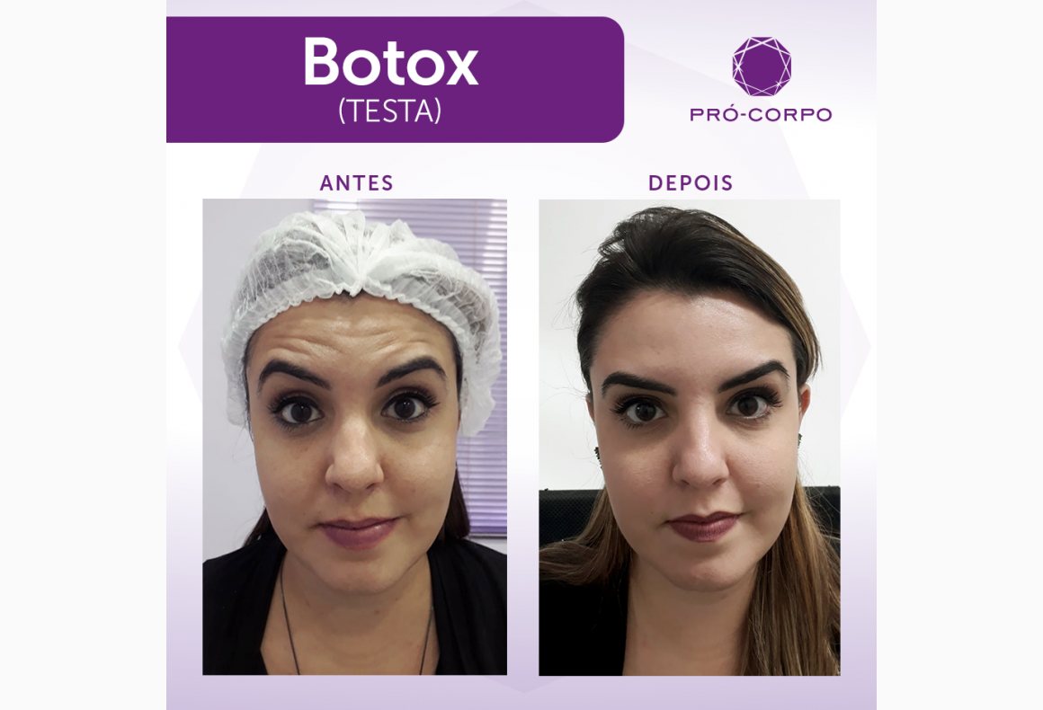 Botox ® Power | Loja Pró-Corpo Estética Avançada | Loja Pró-Corpo