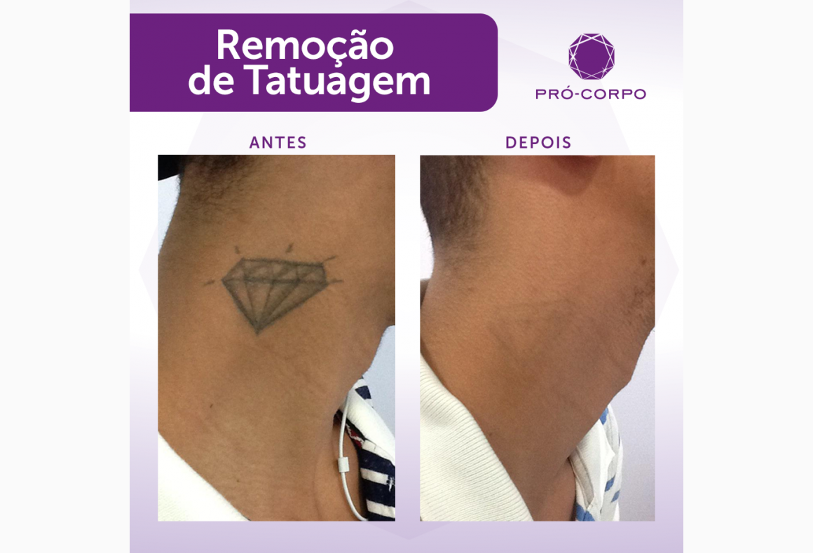 1 sessão de remoção de tatuagem Remocao De Tatuagem De 256 A 440 Cm 1 Sessao Loja Pro Corpo Estetica Avancada