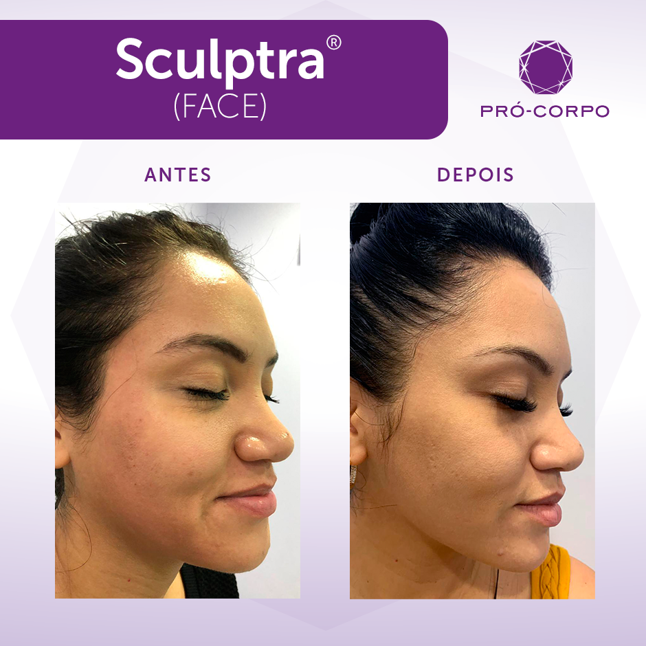 Ellansé Ou Sculptra Qual O Melhor Sculptra ® (1 frasco) | Loja Pró-Corpo Estética Avançada