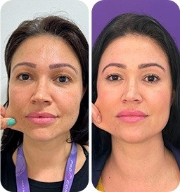 Sculptra ® (1 frasco)