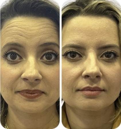 Botox ® Power (50 un)