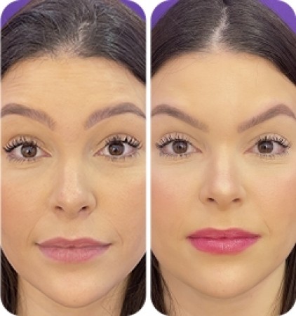  Botox ® Light (25 un)