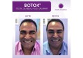 Botox ® Light