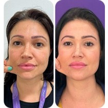 Sculptra ® (1 frasco)
